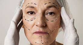 Blefaroplastia