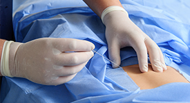 Ninfoplastia